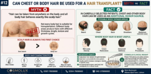 Chest or Body Hair Be Used for a Hair Transplant
