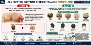 Chest-or-Body-Hair-Be-Used-for-a-Hair-Transplant